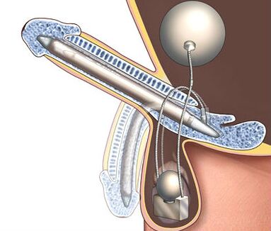 penis enlargement prostheses